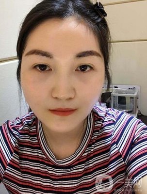 广西医科大一附院整形科正颌案例